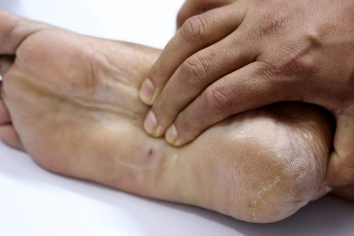 What is the fastest way to heal cracked heels