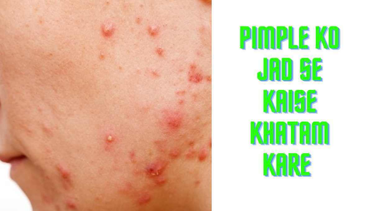 pimple ko jad se kaise khatam kare